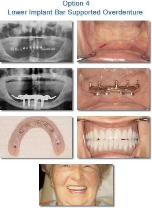 Lower Implant Bar Supported Overdenture - Dental Implants