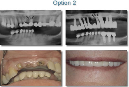 Dental Implants - Porcelain to Metal Implant Supported Bridgework