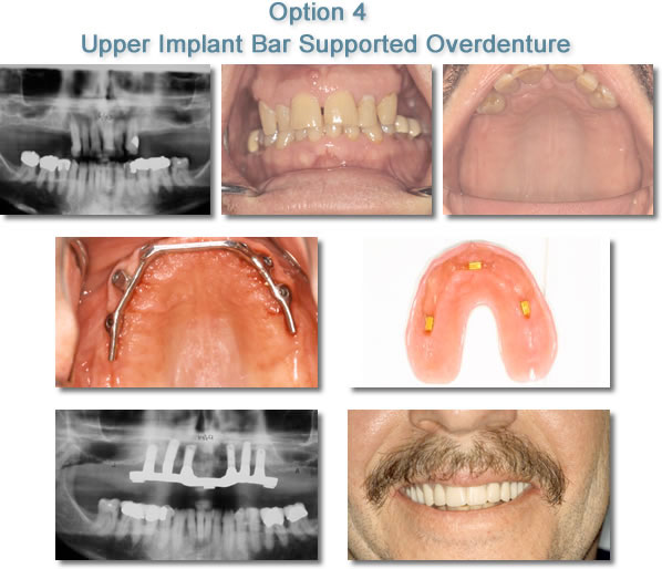 Dental Implants - Upper Implant Bar Supported Overdenture