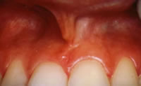 After Frenectomy