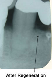 After Bone and Tissue Regeneration