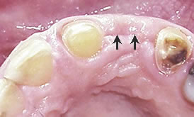 After Ridge Augmentation