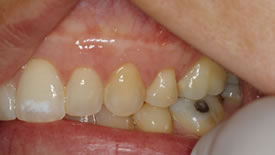 After Crown Lengthening