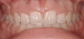 Before Crown Lengthening