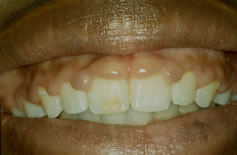 Before Gum Contouring