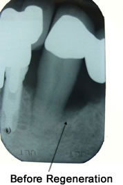 Before Bone and Tissue Regeneration