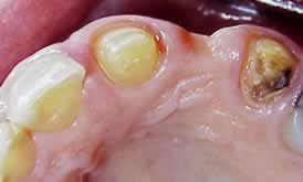 Before Ridge Augmentation