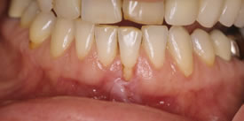 Before Crown Lengthening