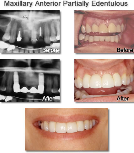 Maxillary Anterior Partially Edentulous