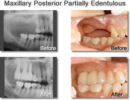 Maxillary Posterior Partially Edentulous