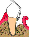 Tooth During Pocket Depth Reduction