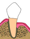 Tooth After Pocket Depth Reduction